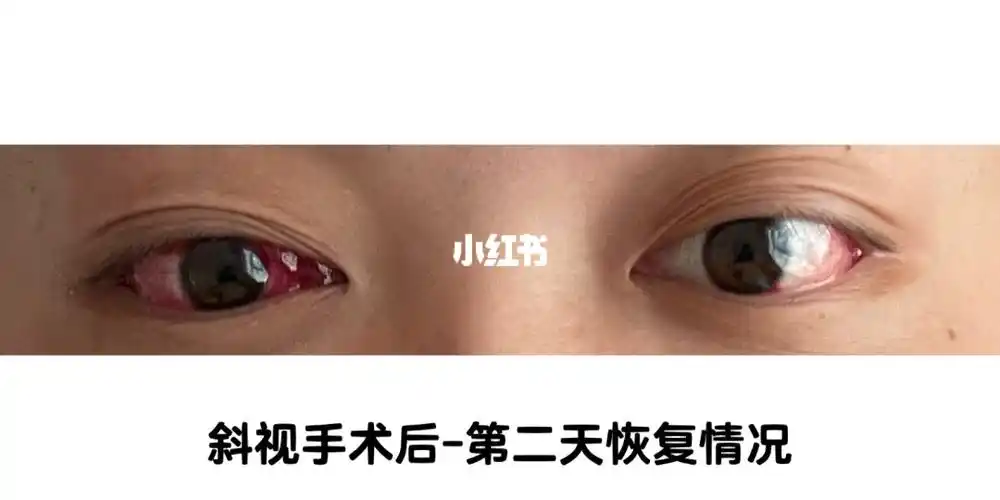 慎入05斜视手术第二天