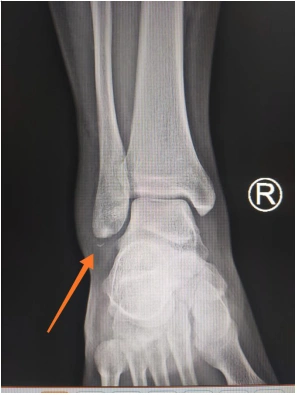 给小夏进行了仔细检查,检查结果为右外踝骨折,右外踝关节侧副韧带断裂