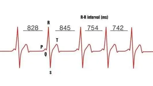 我做了动态心电图,说我心率变异性分析值异常,其中rmssd为78,pnn50为