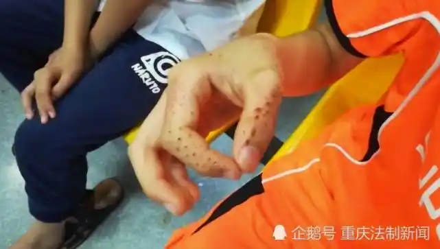 再一看弟弟,手上,脖子上还有耳朵上,布满了密密麻麻的小刺