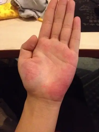 哪位懂中医的大神帮我看看我的手掌常年都是红的,最近盘佛珠红的地方