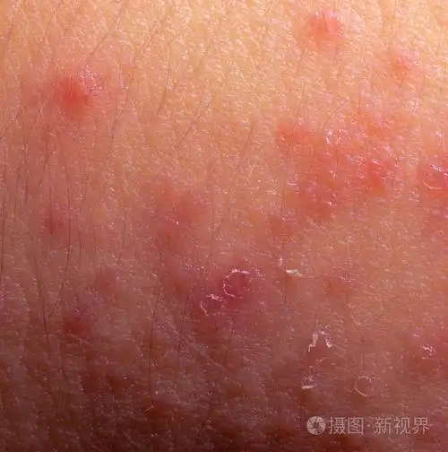 湿疹特应性皮炎症状皮肤质地