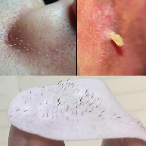 粉刺螨虫的快速去除方法,五大有效妙招