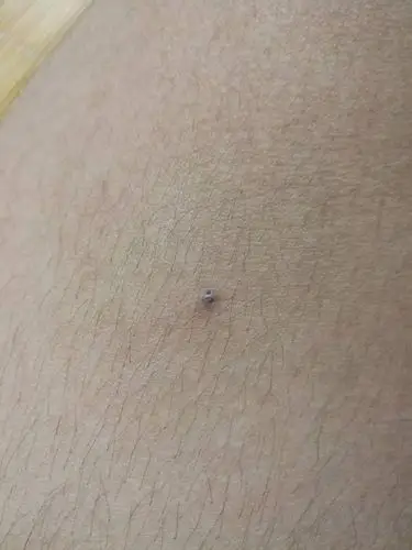 腿上长了个黑色的小包,两边破了出来的东西很硬,请问是什么