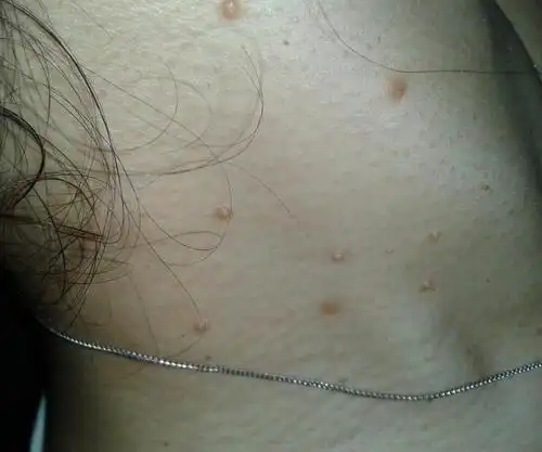 脖子上长了些疙瘩,不疼不痒,挤也挤不掉.