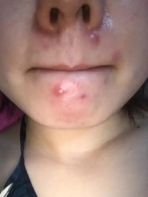 一上火就起疙瘩,这到底是痘痘还是痤疮什么的?怎么治啊?疼!