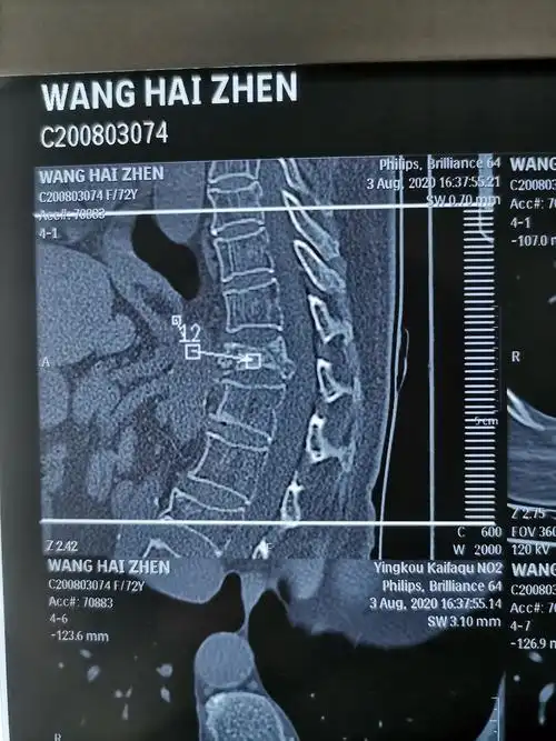 12胸椎体爆裂骨折