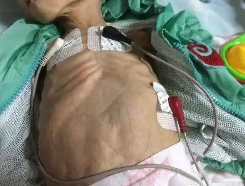 心酸!1岁小婴儿每天"无原因"腹泻上百次,消瘦得不成人形-母婴频道-手