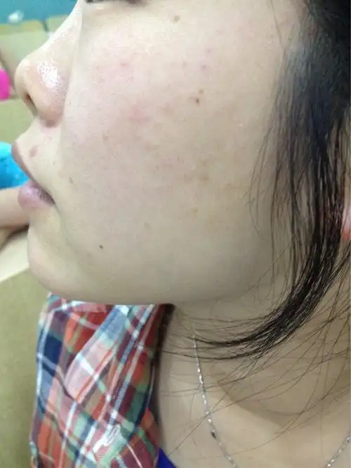 求脂溢性皮炎治愈方法!