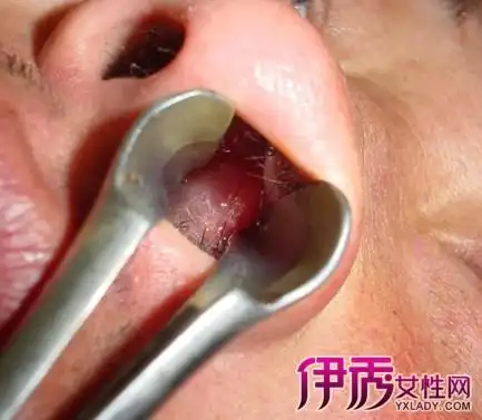 【图】鼻子里面长肉疙瘩是怎么回事 3种绝招帮您摆脱困扰