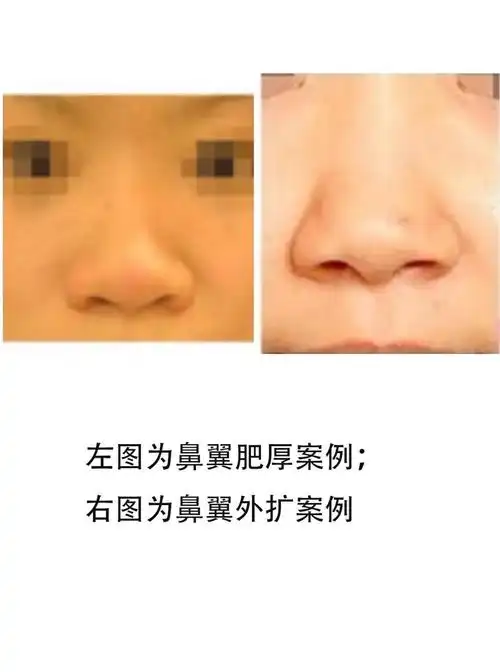 94精致感杀手——鼻翼外扩,宽大该如何解决_圈子-新氧美容整形