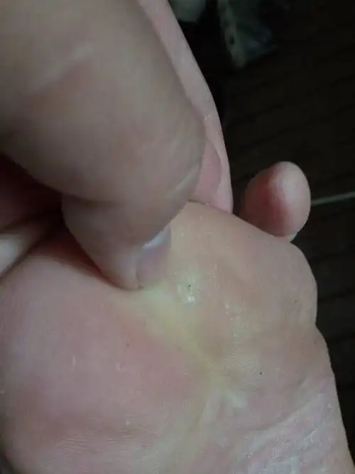 前脚掌这个地方疼,有浆子,呆着不疼,走路或者碰到就疼,这是什么原