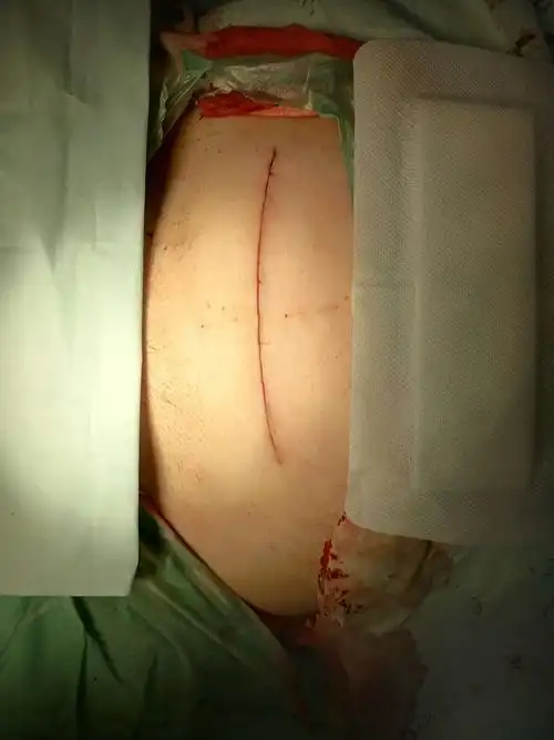 剖宫产术后刀口应该如何护理?