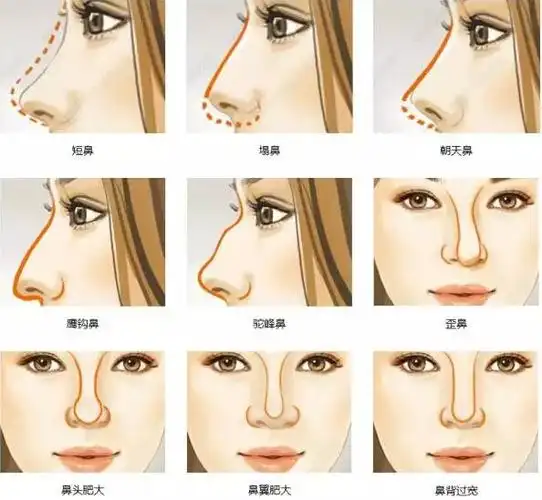 昆明华美美莱的肋软骨隆鼻不是所有人都适合