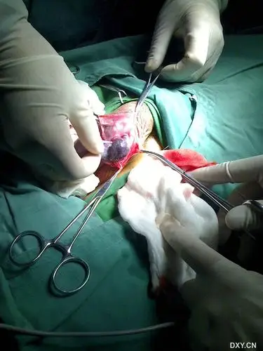 送上手术图片!