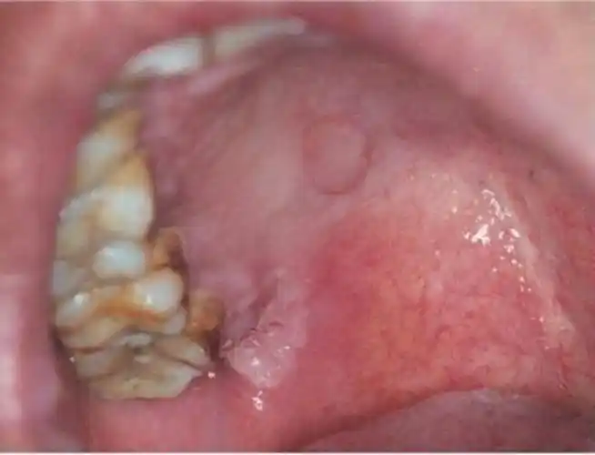 一期梅毒初期生殖器图片