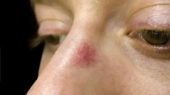 肝癌常常皮肤上会有四种变化,十个人九个都会忽视,最好去查一下