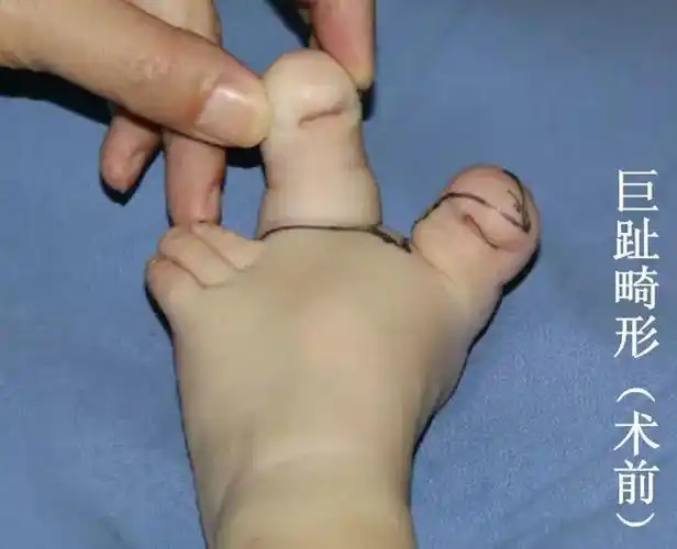 名医问诊六指怪这个话题让家长害怕但不容忽视