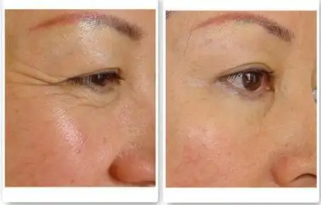 去鱼尾纹前后对比