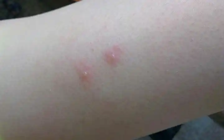 螨虫咬了不会有这么大的包吧…  2013-07-10 14:46  最佳答案 肯定是