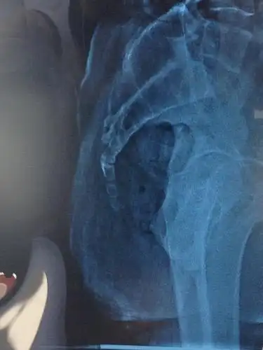 x13837:尾骨侧位片 - x线病例讨论 医影在线