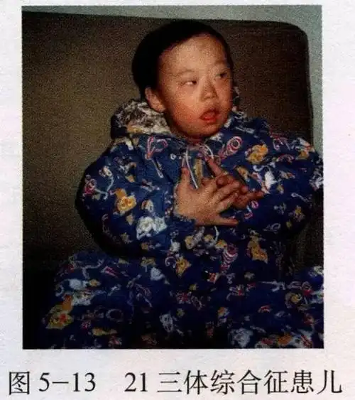 中国唐氏儿收养机构 买了保险唐氏儿能报销吗