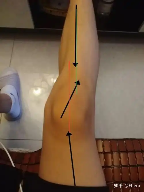 膝盖周围变得弯曲,要怎么改善? - 知乎