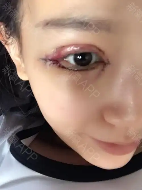 郑州开外眼角好不好_效果图_果冻r开外眼角术后第1天_新氧美容整形