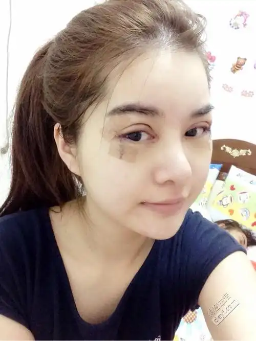 双眼皮后一周的恢复照片