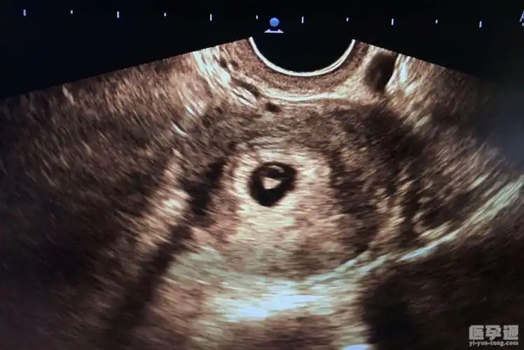 42天孕囊男女到底怎样看更准总结三个方面90的妈妈们都说准