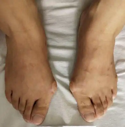 拇外翻微创手术预约中