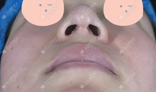 做完假体隆鼻以后出现疤痕增生该咋办呀会自愈吗