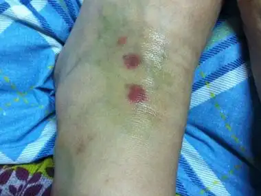 可表现为红斑形状为类圆形,突起于表面,大小不一,与皮肤表面持平,患者