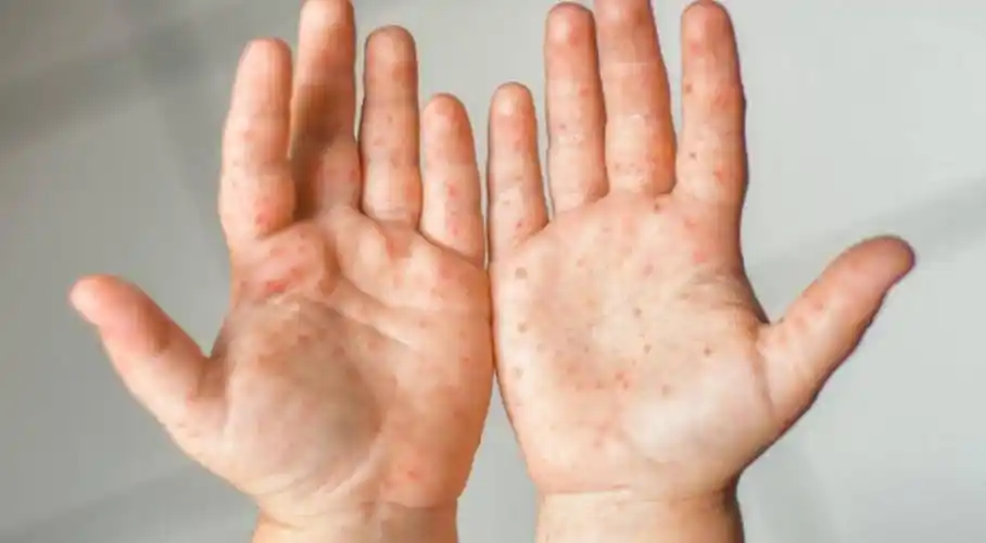 安省卫生部警告麻疹恐开始社区传播可空气传播比新冠还快