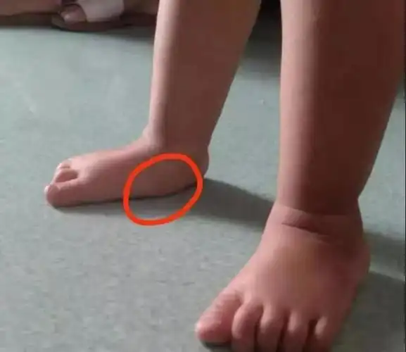 扁平足能治疗吗(扁平足怎么办需要治疗吗)(7)