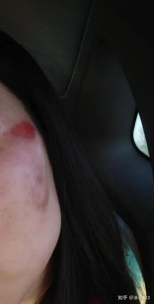 脸部擦伤如图请问如何恢复