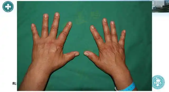 进行性骨干发育不全检查方法有生化检查x线检查预后较好