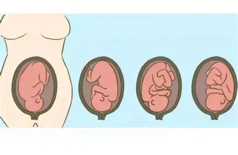 枕横位是胎儿以头部朝下,枕部位于产妇骨盆侧方的胎方位.