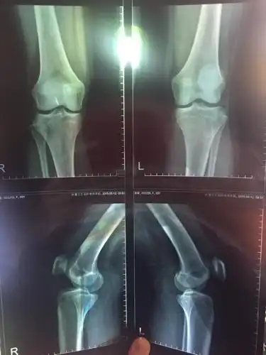 我今年十五岁,昨天拍了膝盖的片子,大夫说我有骨质增生,但是报告