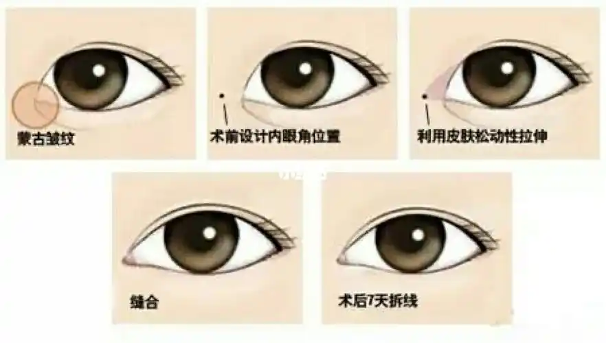 什么叫内眦赘皮?_内眼角_双眼皮_美妆_医美整形
