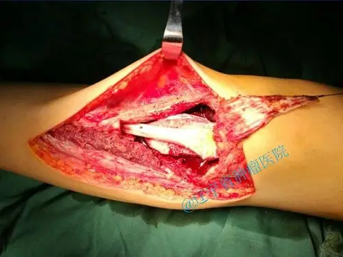 胫骨动脉瘤样骨囊肿病例分享 - 好大夫在线