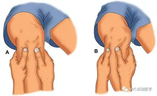 患者平卧位,屈膝90°屈髋45°,胫骨外旋15°,固定足,进行后抽屉试验