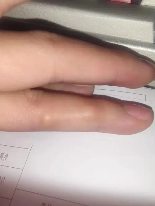 求助手指关节处长了两个跟老茧一样的包