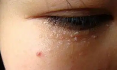 教你几个消除脂肪粒的方法 还你光洁无瑕的皮肤