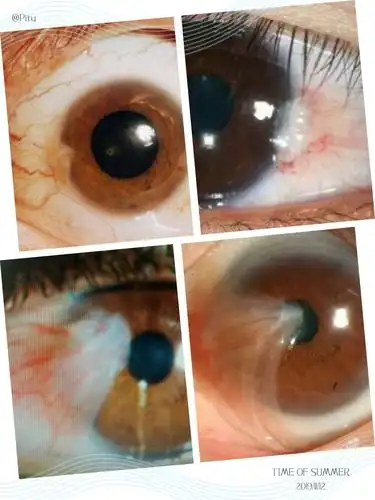 眼睛也能长"息肉"吗?