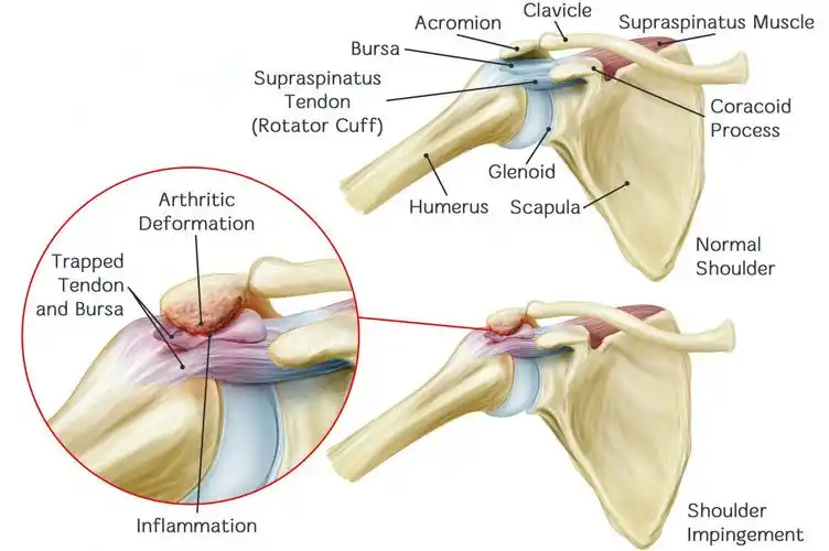 肩关节疼痛之肩峰撞击综合征_肩关节损伤_介绍_发病原因_检查_治疗