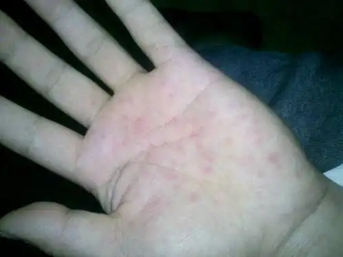 洗澡后手心出现很多红点,按压后有点刺痛.