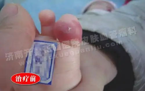 【治疗前】:患儿脚趾头上的血管瘤治疗前的照片