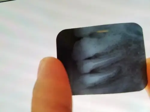 69 口腔医学专业讨论版 69 根尖处这样大的阴影《附牙片》要怎么