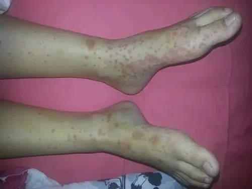 荨麻疹性血管炎症状